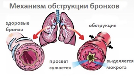 1. Сужение дыхательных путей